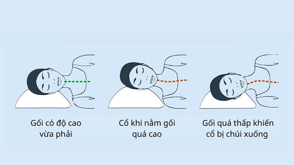 Gối cho người đau cổ vai gáy cần có độ cao vừa phải và phù hợp với tư thế nằm